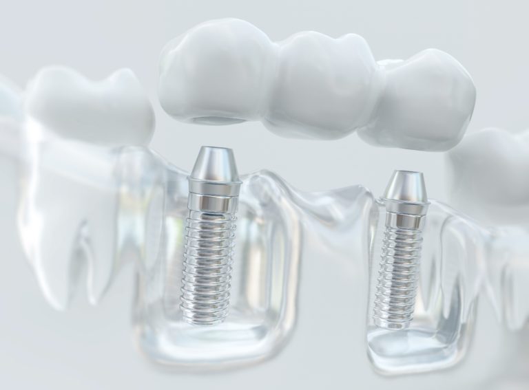 sideview of dental implants