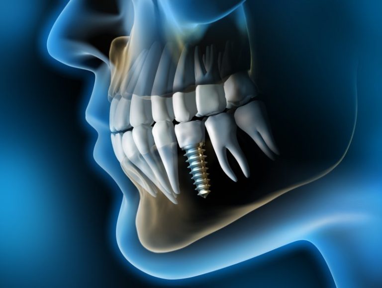 side view x-ray of dental implant